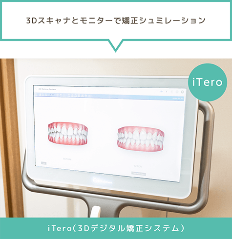 「3Dスキャナとモニターで矯正シュミレーション」iTero(3Dデジタル矯正システム)